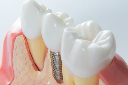 Rebuild Your Smile Using Dental Implants